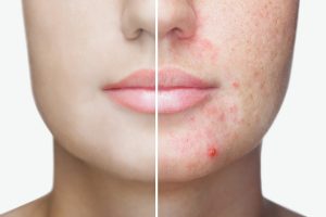 Acne Laser Clinic Adelaide