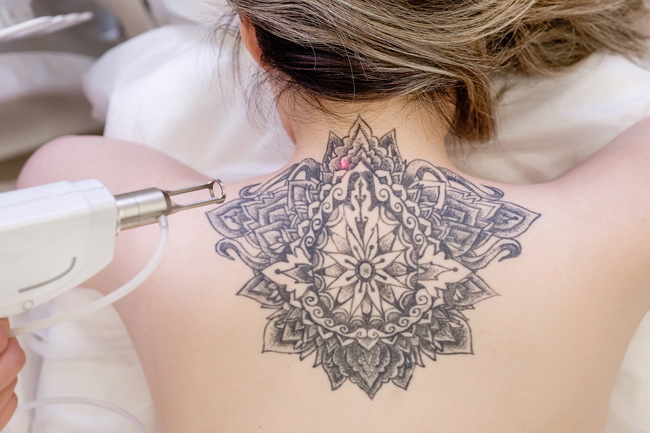 Laser Tattoo Removal Adelaide | Laser Hair Removal Adelaide | LaserYou