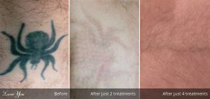 tattoo removal adelaide