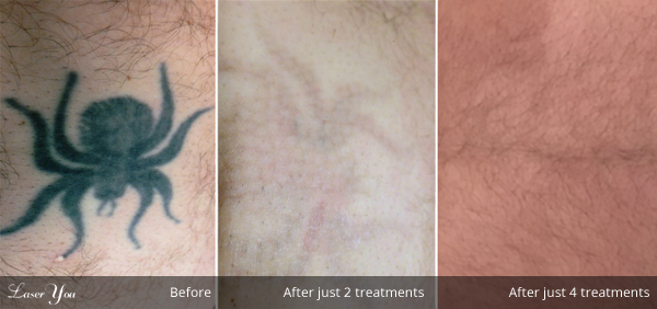 laser-tattoo-removal-2 -