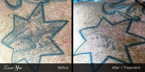 laser-tattoo-removal-adelaide