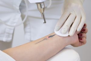 Laser Tattoo Removal Adelaide Laser Clinic