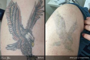laser-tattoo-removal-before-after