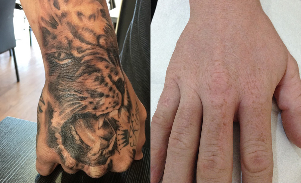 Laser Tattoo Removal Adelaide - Before & After