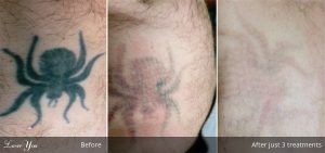 tattoo_removal_adelaide